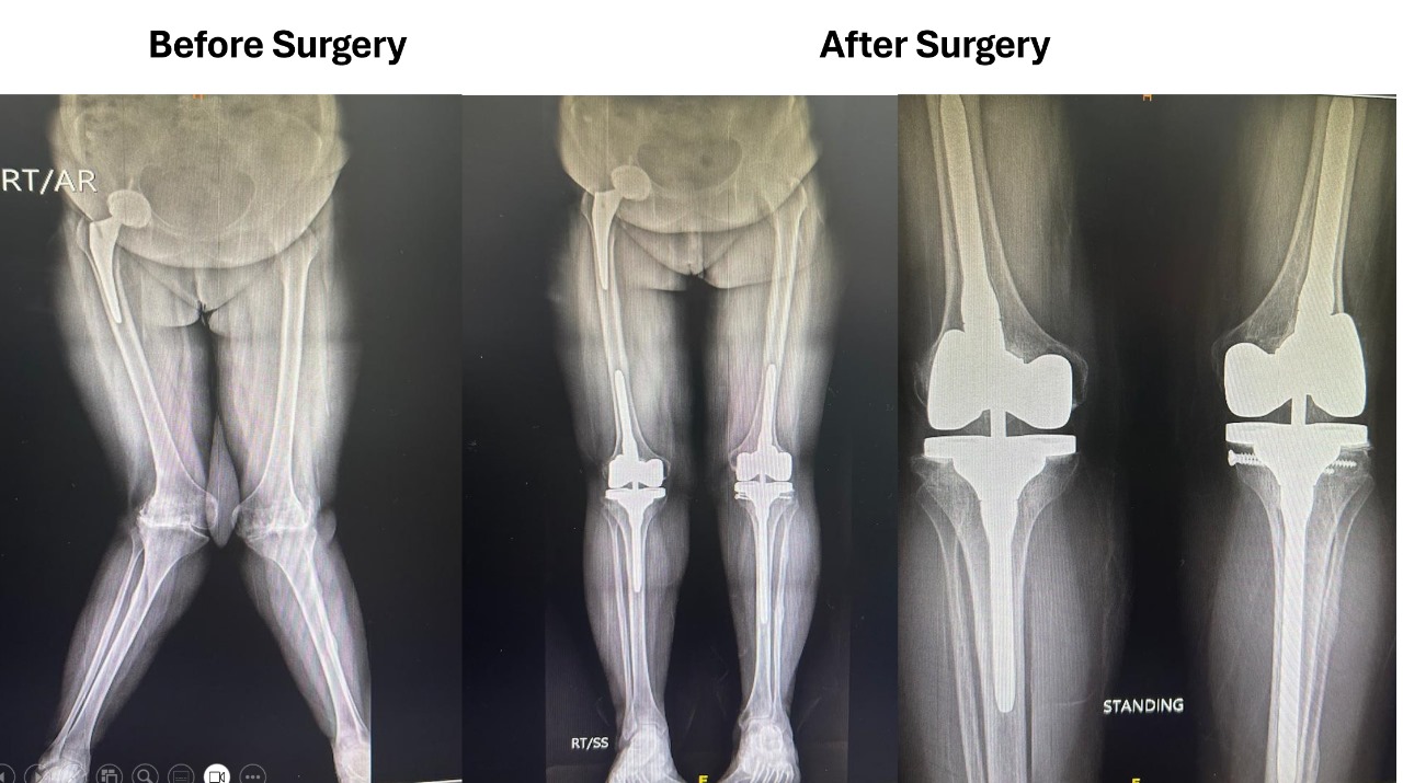 Hip and Knee Replacement in South Delhi | Dr. Yashwant Singh Tanwar